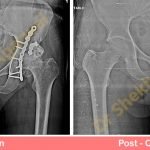 Best Hip Replacement Surgery Hospital in Delhi, India