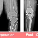 Best Knee Joint Replacement Surgery Hospital in Delhi NCR India