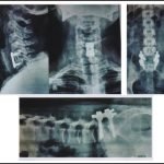 Best Spine Surgery Hospital in Delhi NCR – DITO