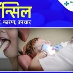 Tonsil Stones: Causes, Symptoms, And Treatment In Hindi